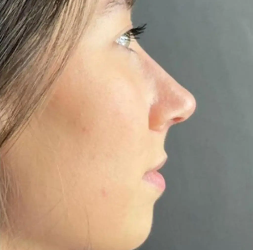 Patiente avant le traitement, photographiée en blouse clinique sur fond sombre