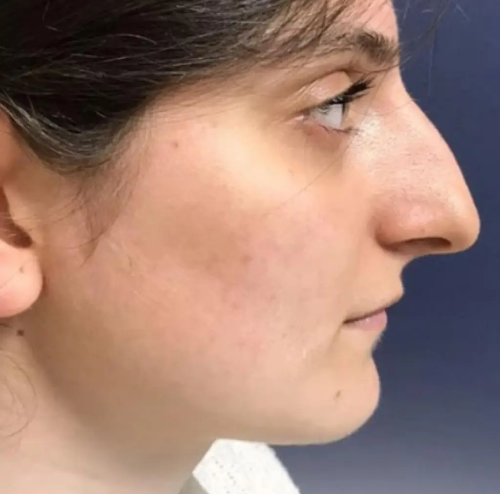 La même patiente photographiée après le traitement