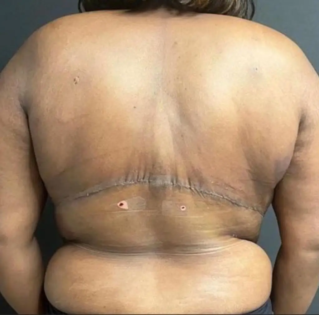 Patiente avant le traitement, photographiée en blouse clinique sur fond sombre