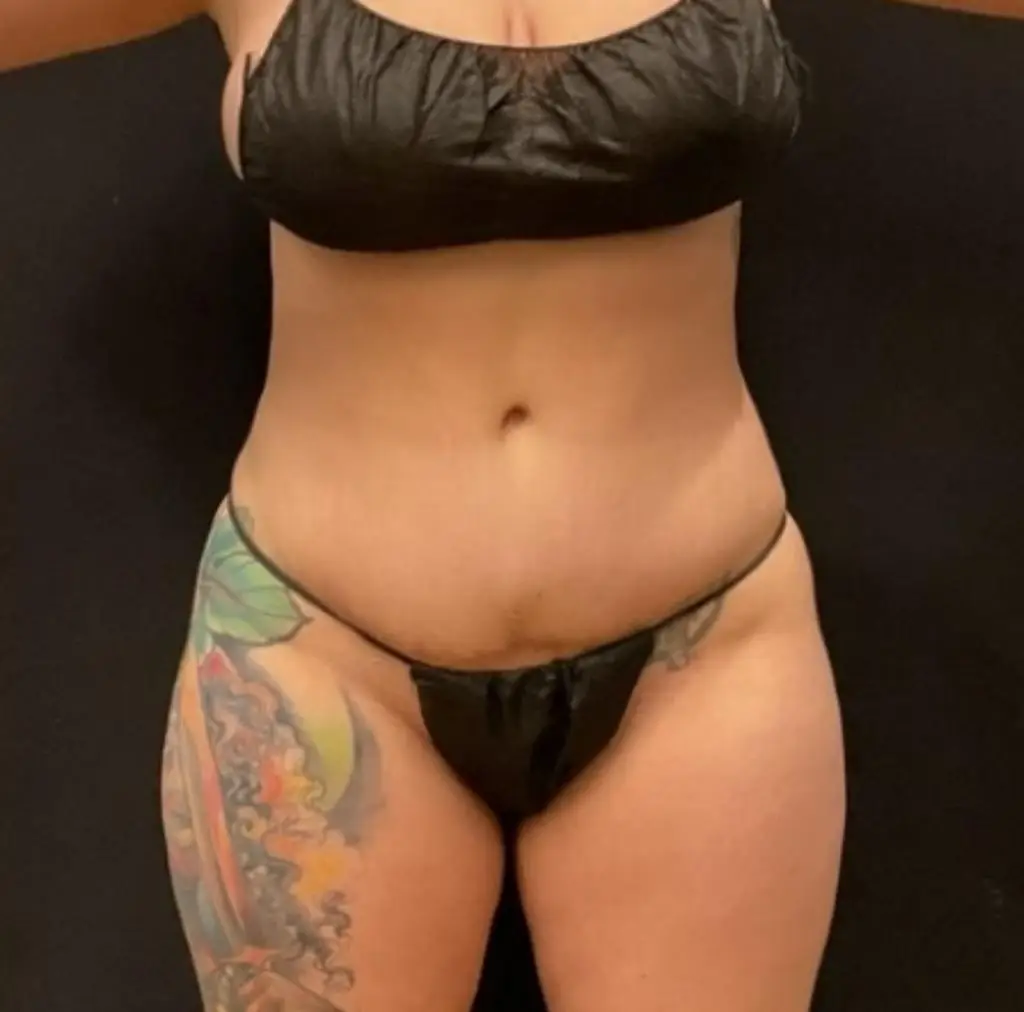 Patiente avant le traitement, photographiée en blouse clinique sur fond sombre