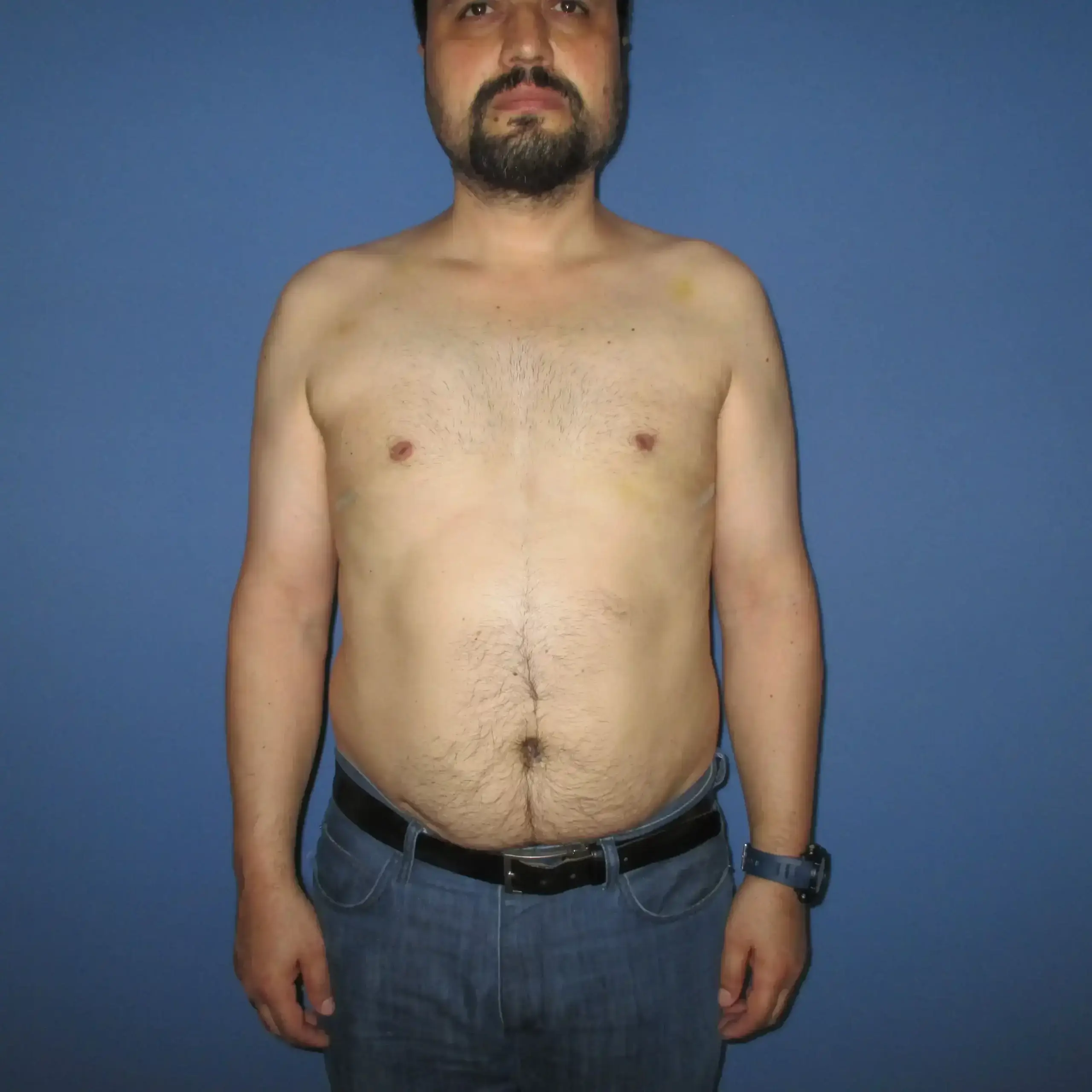 Patiente avant le traitement, photographiée en blouse clinique sur fond sombre
