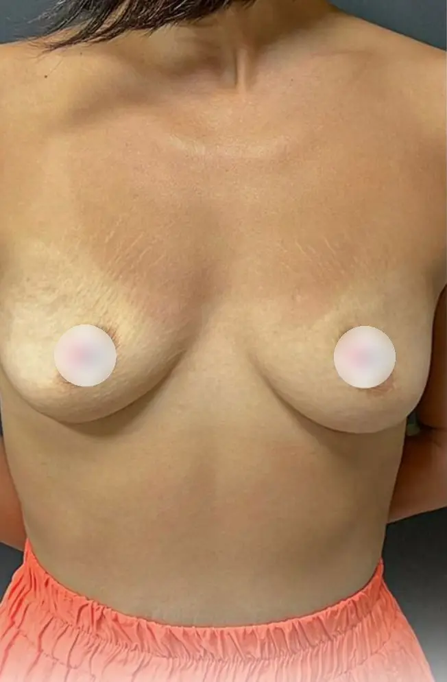 Breast augmentation, Before