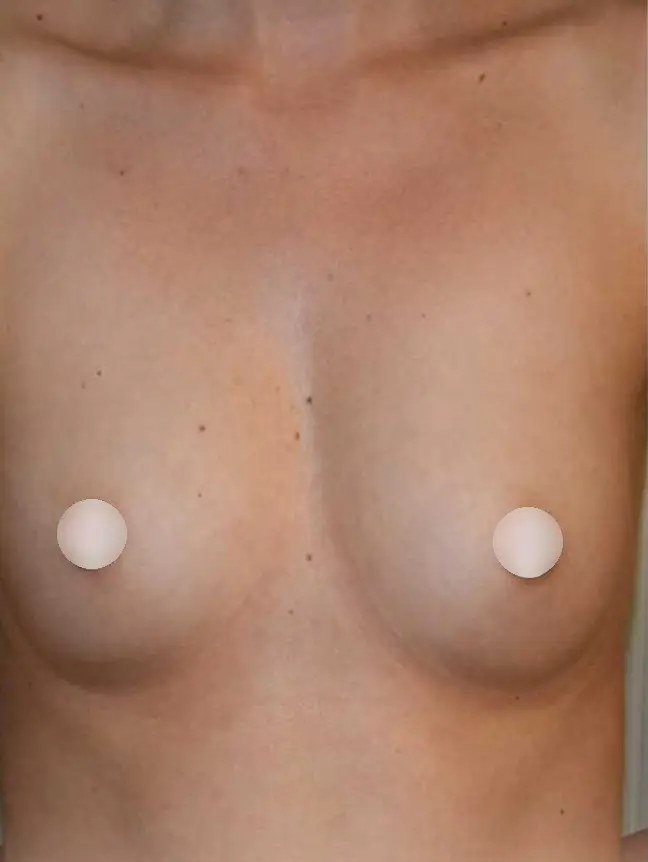 Breast augmentation, Before