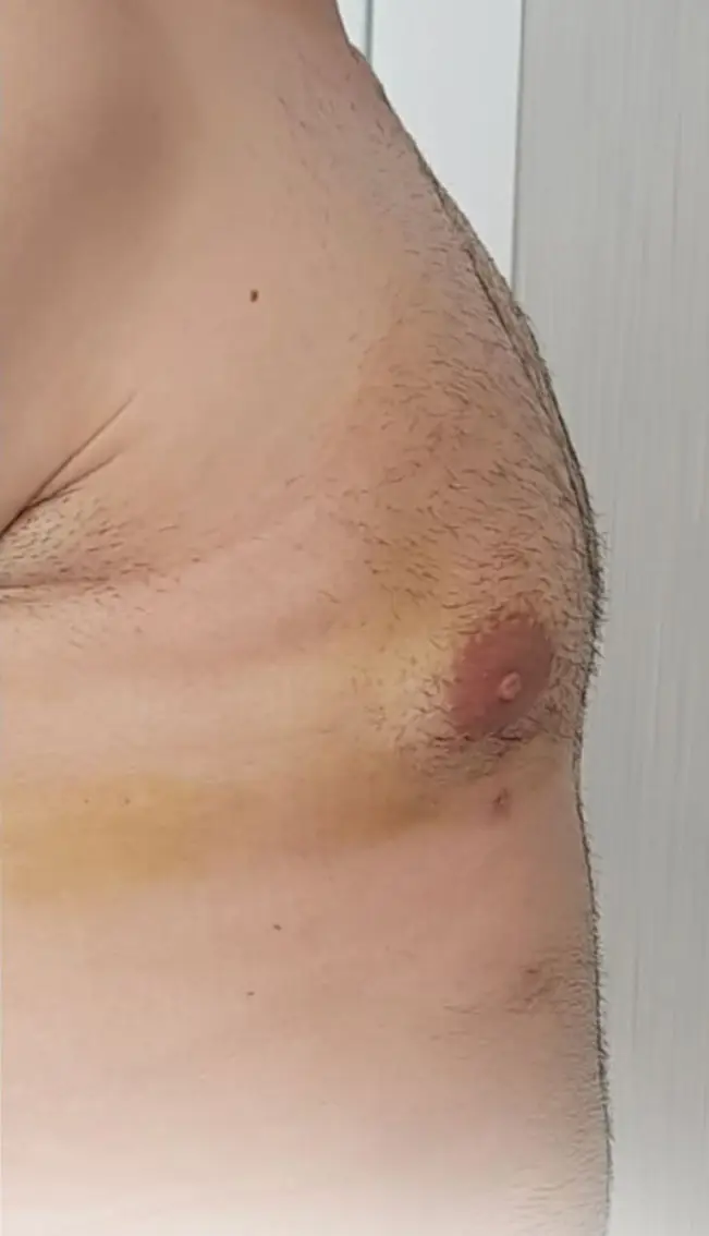 Gynecomastia surgery, After