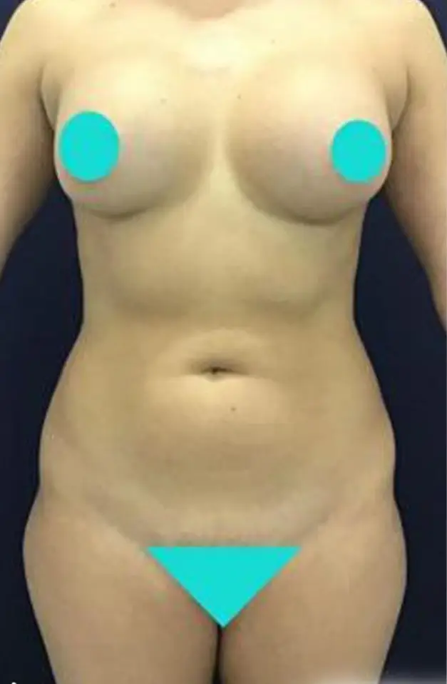 Liposuction, Before