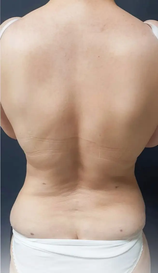 Liposuction, After