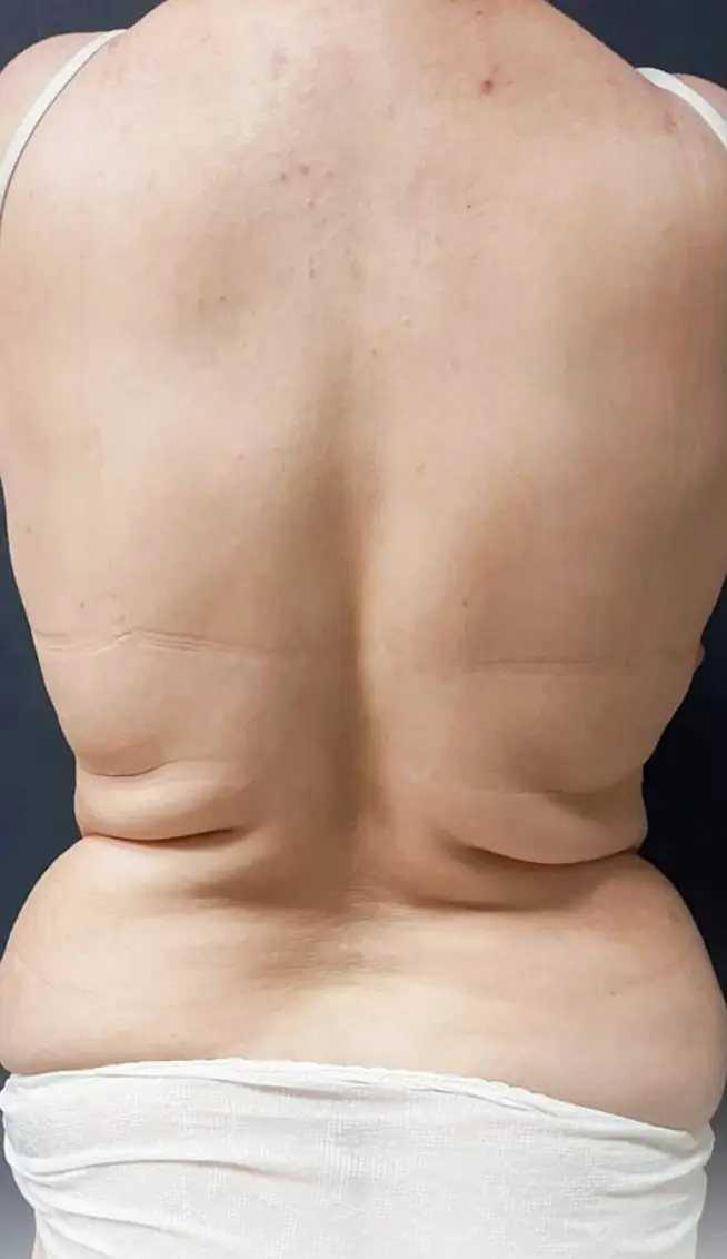 Liposuction, Before