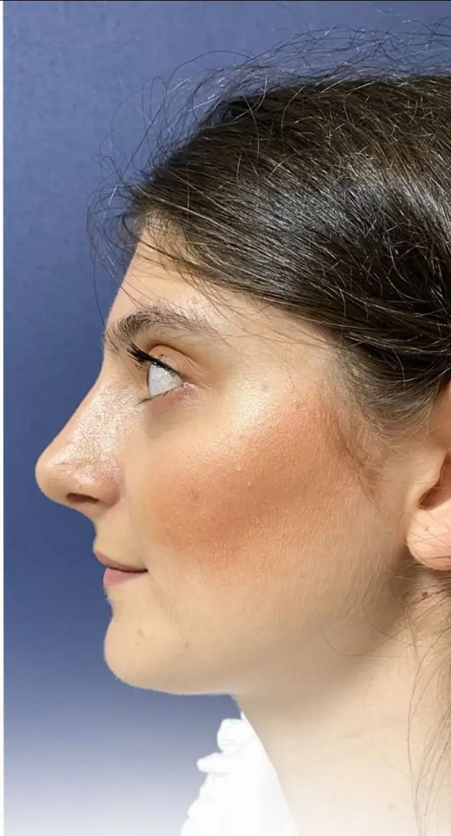 Rhinoplasty, After
