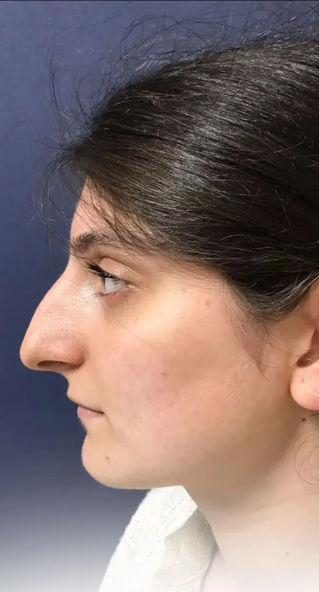Rhinoplasty, Before