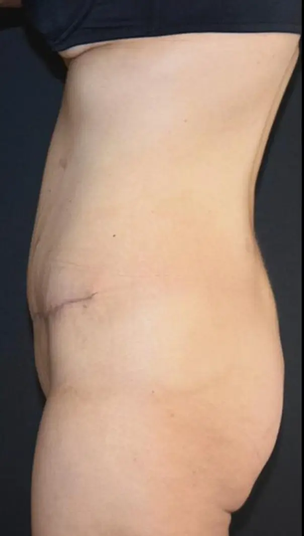 Tummy tuck, After