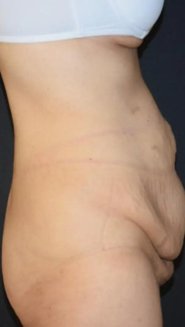 Tummy tuck, Before
