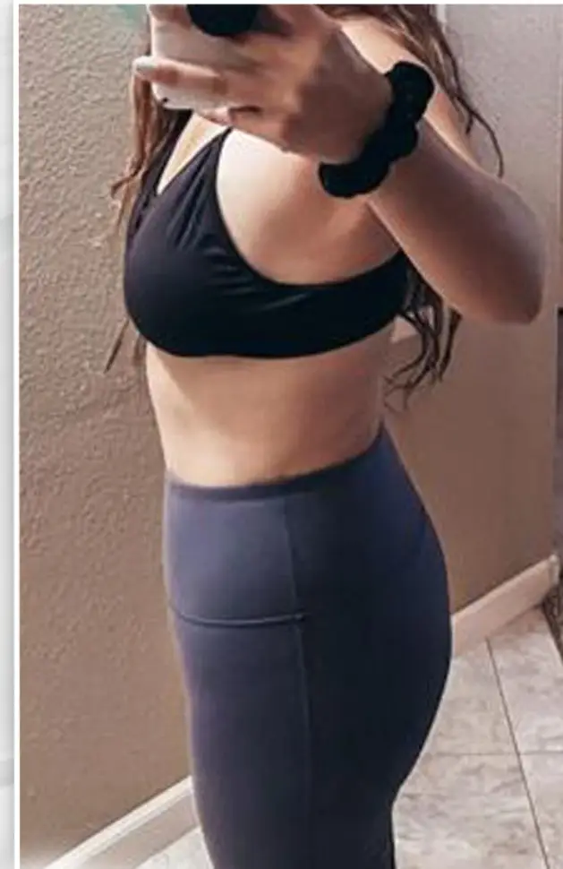 Tummy tuck, After