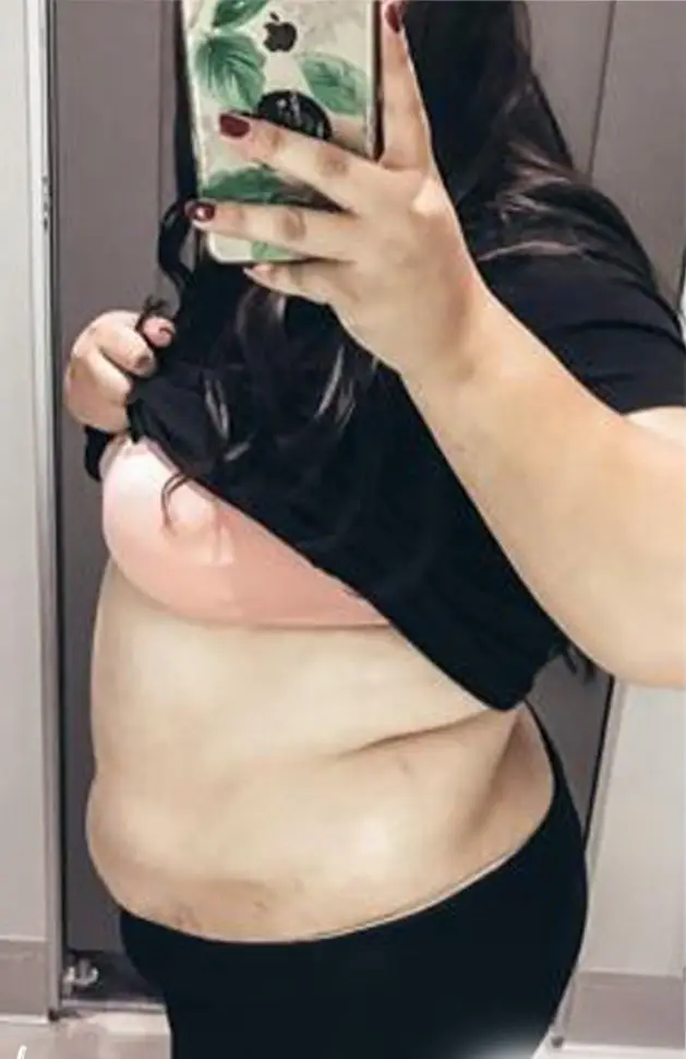 Tummy tuck, Before