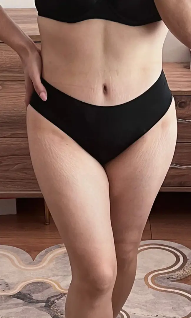 Tummy tuck, After