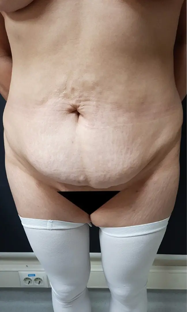 Tummy tuck, Before