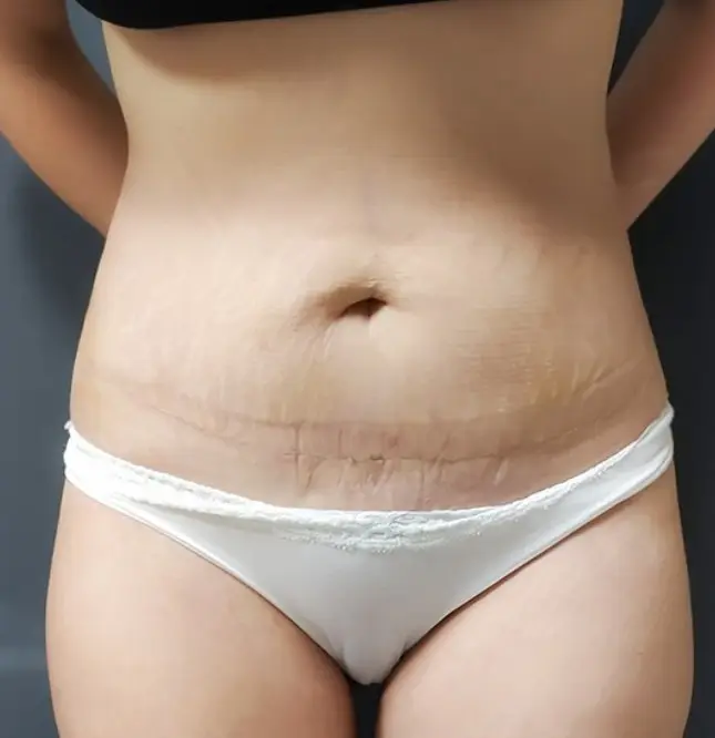 Tummy tuck, After