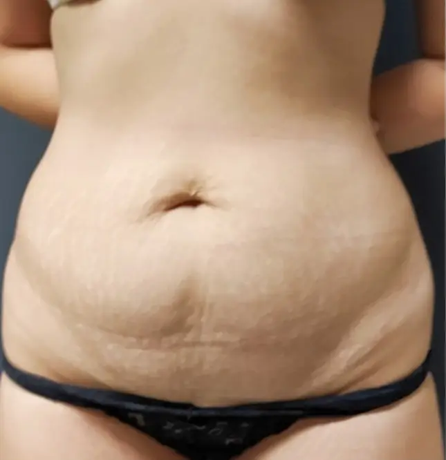 Tummy tuck, Before