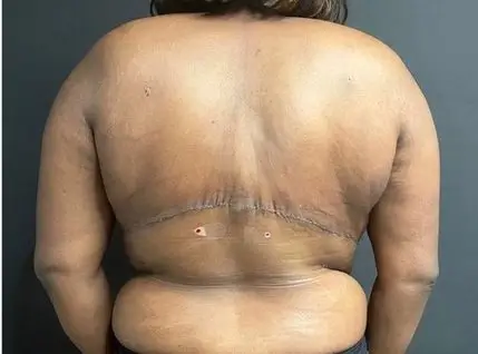 Liposuction, After