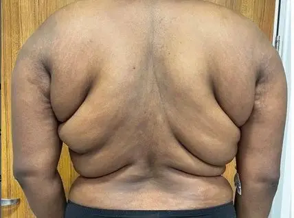 Liposuction, Before