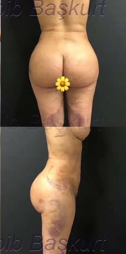 Brazilian butt lift, After