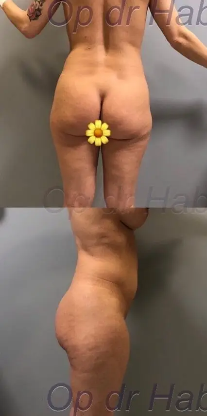 Brazilian butt lift, Before
