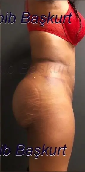 Brazilian butt lift, After