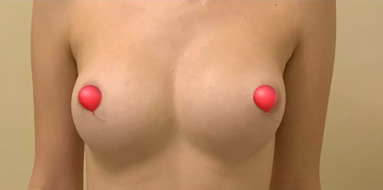 Breast augmentation, After