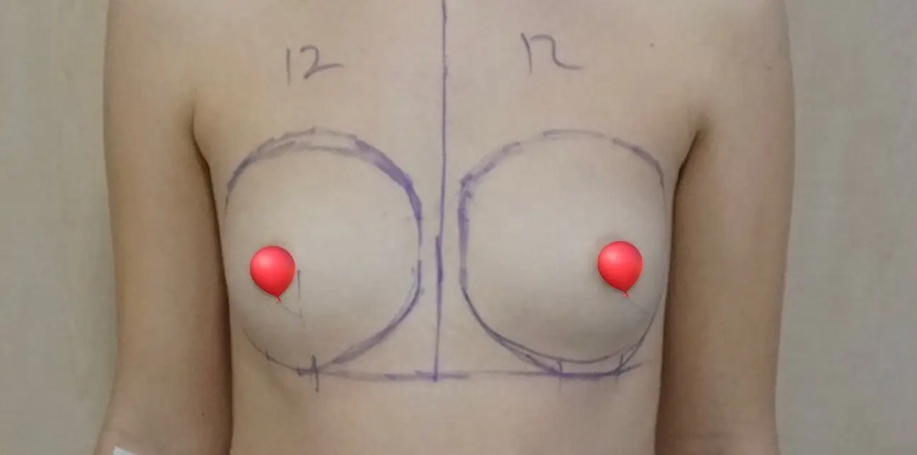 Breast augmentation, Before