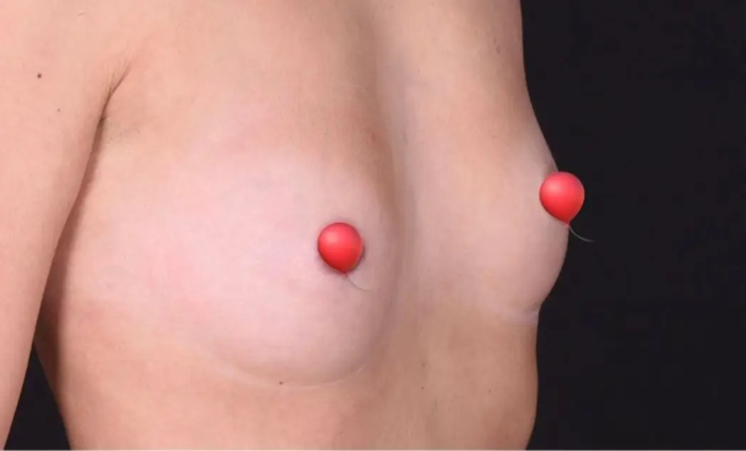 Breast augmentation, Before