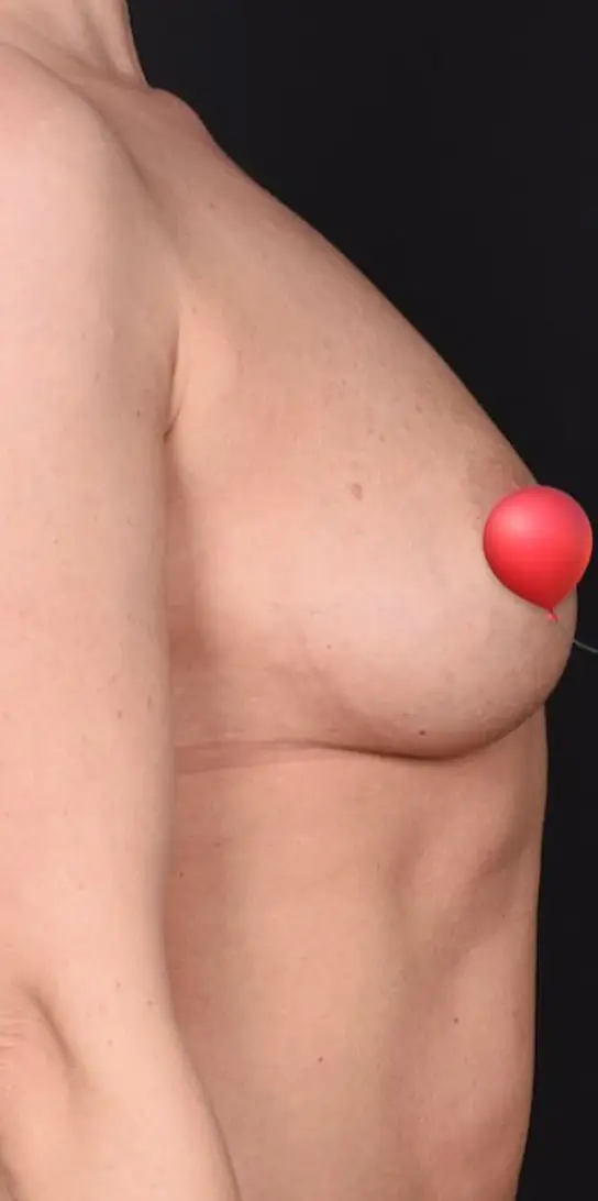 Breast augmentation, Before
