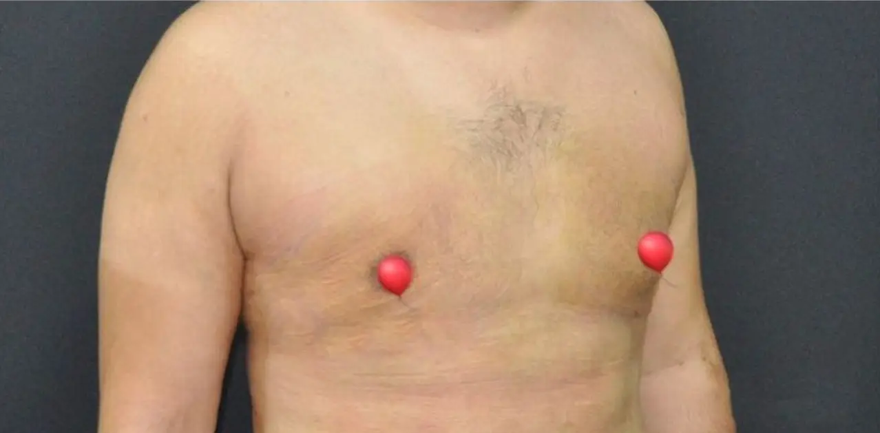 Gynecomastia surgery, After