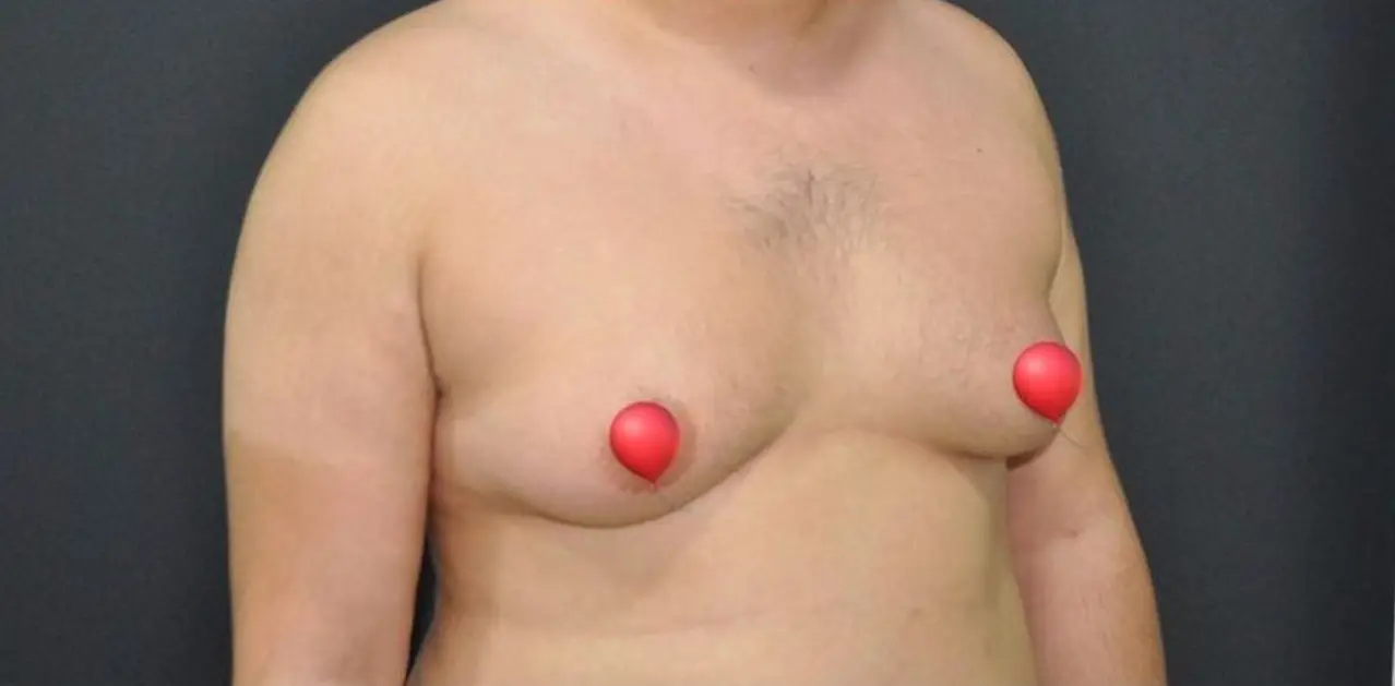 Gynecomastia surgery, Before