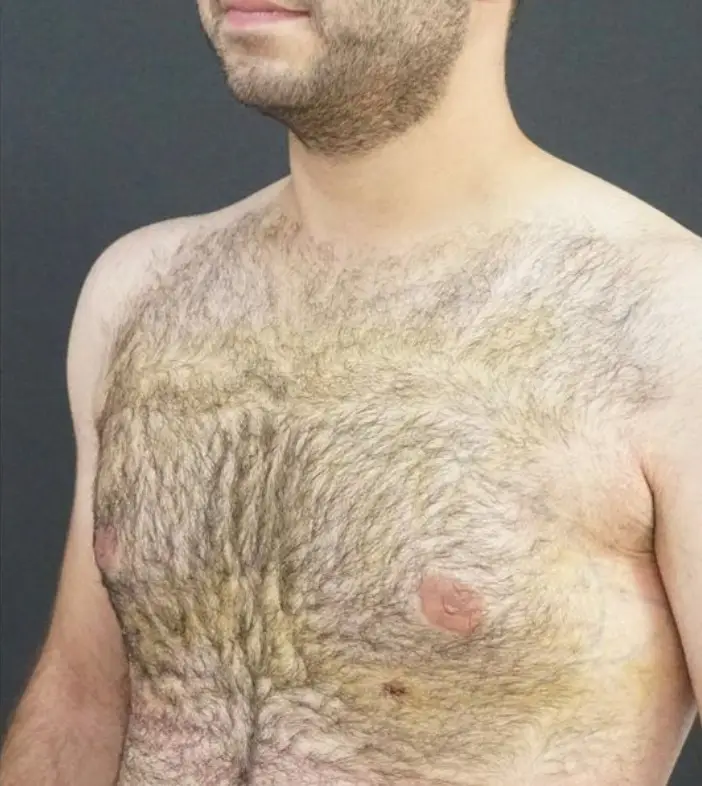 Gynecomastia surgery, After