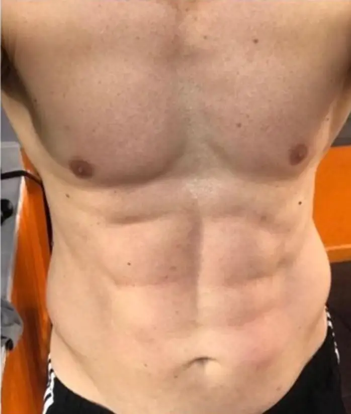 Liposuction, After