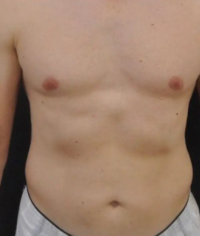 Liposuction, Before