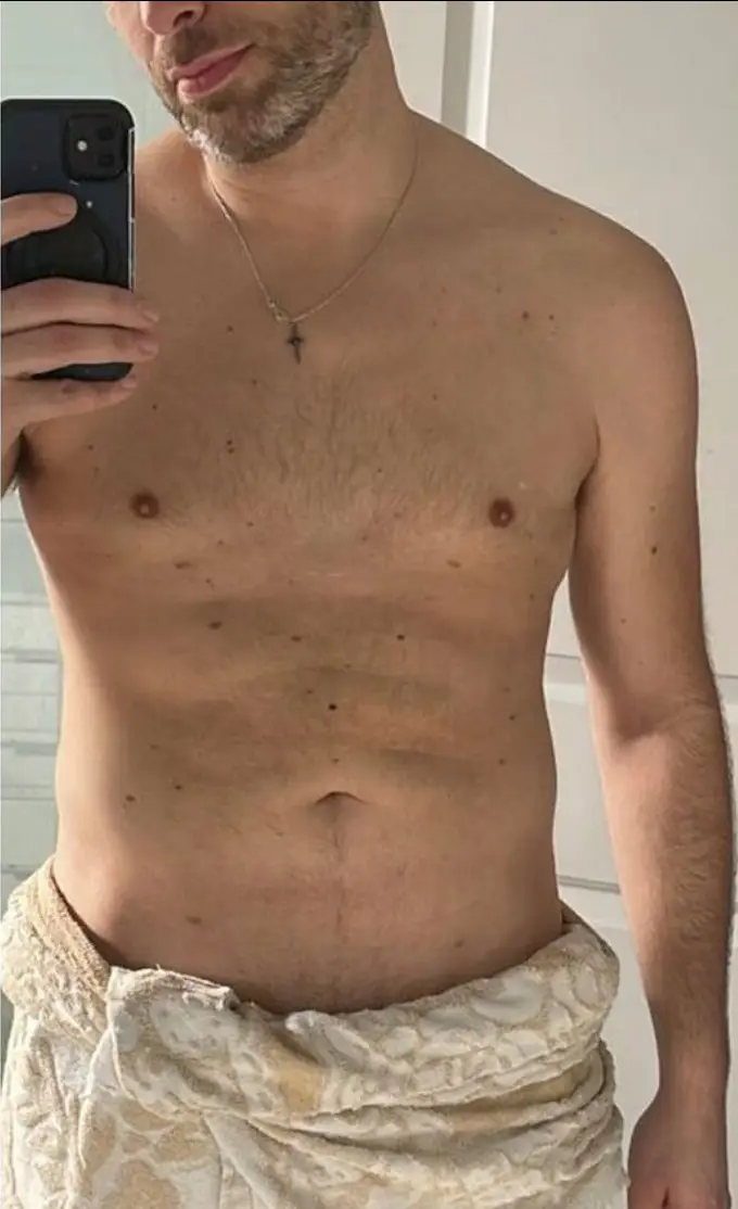 Liposuction, After