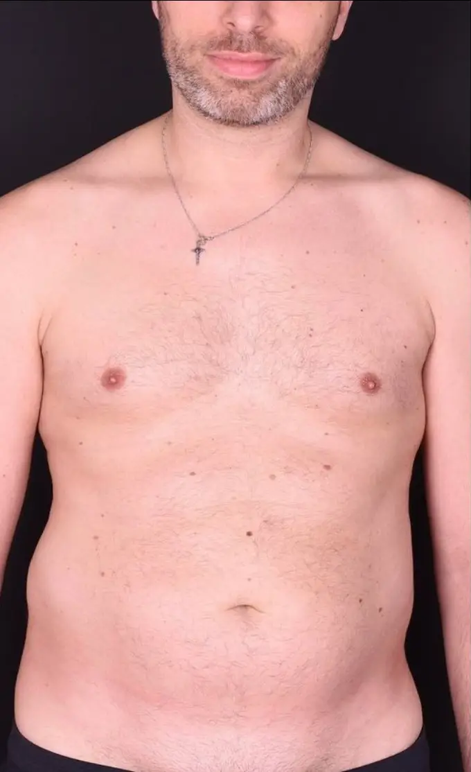 Liposuction, Before