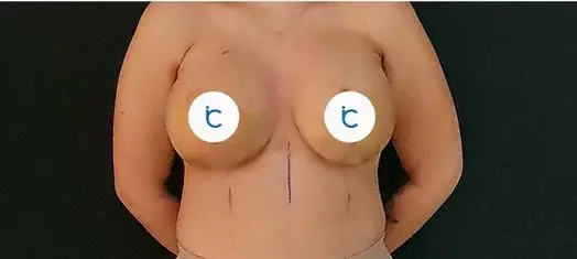 Breast augmentation, After