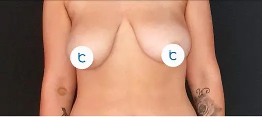 Breast augmentation, Before