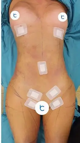 Body contouring, After