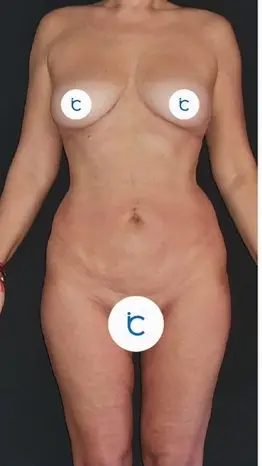 Body contouring, Before
