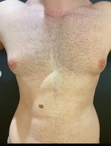 Gynecomastia surgery, Before