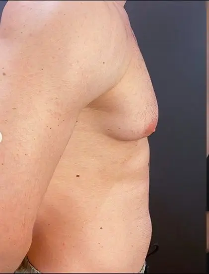 Gynecomastia surgery, Before