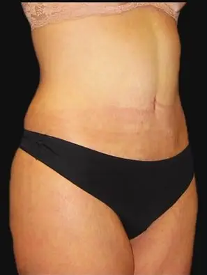 Tummy tuck, After