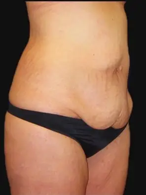 Tummy tuck, Before
