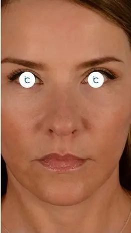 Facelift, After