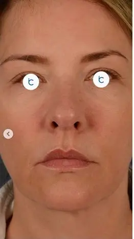 Facelift, Before