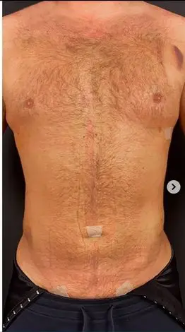 Tummy tuck, After