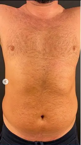 Tummy tuck, Before