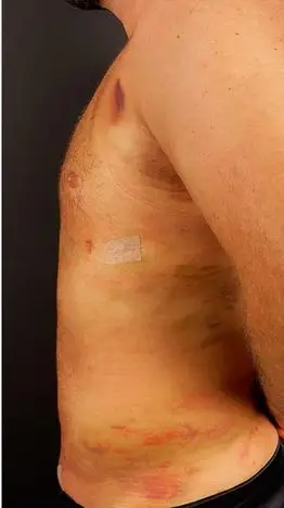 Liposuction, After
